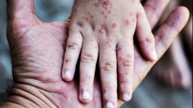 Sarampión: El brote sumó un nuevo caso y hay 500 personas en vigilancia epidemiológica