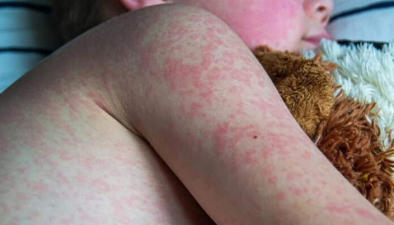 La Provincia alerta por avance de otro brote de sarampión