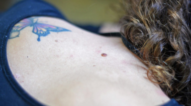 El Municipio adhiere a la Campaña Nacional de Prevención del Cáncer de Piel