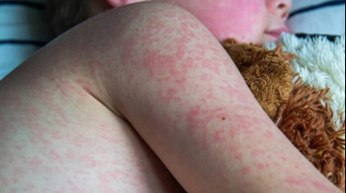 La Provincia alerta por avance de otro brote de sarampión