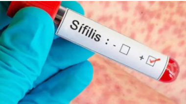 La sífilis acecha: en 2025 se notificaron 46.799 casos en el país